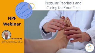 Pustular Psoriasis and Caring for Your Feet [upl. by Germain202]