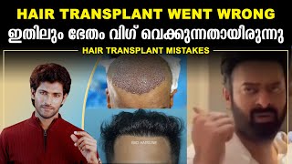 BIG MISTAKES IN HAIR TRANSPLANT  DONT DO THIS [upl. by Haram615]