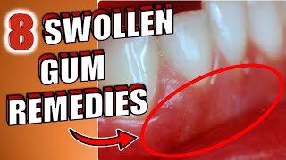 8 Home Remedies To Get Rid of Swollen Gums [upl. by Mailliwnhoj83]