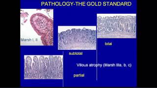 Celiac Disease and Non Celiac Gluten Wheat Sensitivity [upl. by Felipa]