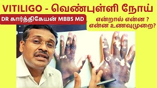 vitiligo skin problem treatment foods home remedies  வெண்புள்ளி நோய் உணவுமுறை [upl. by Anilahs829]