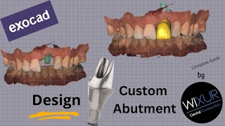 Design A Custom Abutment Maxillary Anterior [upl. by Madge654]