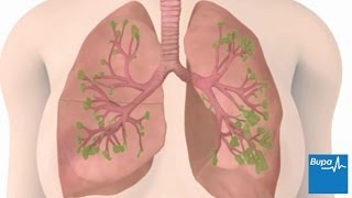 How chronic obstructive pulmonary disease COPD develops  Bupa Health [upl. by Aivil]