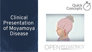 Clinical Presentation of Moyamoya Disease by W Northam et al  OPENPediatrics [upl. by Mohsen]