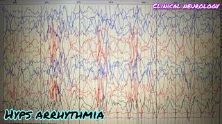 Hyps arrhythmia EEG hypsarrhythmia eeg neurology medicine [upl. by Sherard]