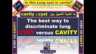 The best way to discriminate cystic lung lesion versus cavity and its impartance [upl. by Carboni170]