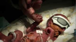 24 week premature baby  Tobys journey [upl. by Alarice]