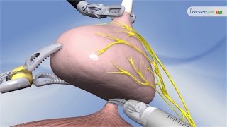 La chirurgia robotica in urologia il futuro degli interventi mininvasivi [upl. by Reinke]