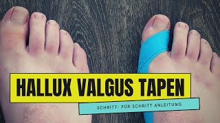 HALLUX VALGUS tapen  So einfach geht es [upl. by Buller597]