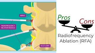 Radiofrequency Ablation  Pros amp Cons [upl. by Ardnuyek]