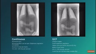 Philips Gridcontrolled fluoroscopy GCF animation video [upl. by Haynor]