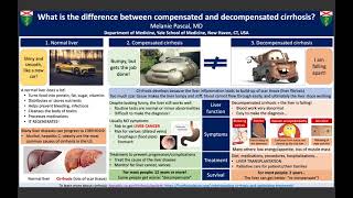 quotWhat is the difference between compensation and decompensated cirrhosisquot  Melanie Pascal [upl. by Atrebor126]