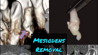 Black  White Version Mesiodens Removal from the Palate [upl. by Maise]