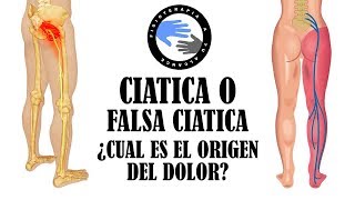 Ciatica o falsa ciatica como diferenciar el sindrome del piramidal de una hernia [upl. by Cock]