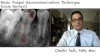 Basic Pulpal Revascularization Case Review with Dr Chafic Safi [upl. by Teik]