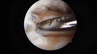 Posterior Ankle Arthroscopy Debridement of Os Trigonum Removal SFISM [upl. by Ahselrac]