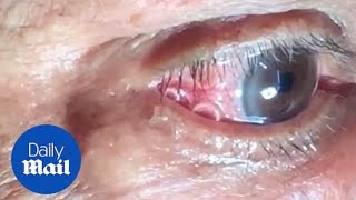 GRAPHIC Moment 15cm long worm is removed from mans eye [upl. by Alodee]