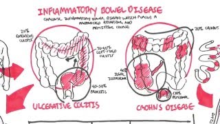 Inflammatory Bowel Disease  Crohns and Ulcerative Colitits [upl. by Anec493]