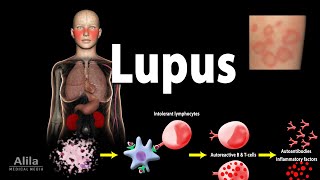 Lupus Symptoms Risk factors Pathophysiology Diagnosis and Treatments [upl. by Winograd955]