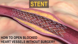 What is a STENT [upl. by Rafferty327]