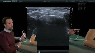 Elleboog  Common extensor tendon dwars  E14  echografie [upl. by Esinet]