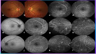 Fundus Fluorescein Angiography FFA Testing [upl. by Acilgna950]