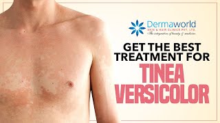 Get The Best Treatment for Tinea Versicolor [upl. by Asselam]