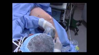 Endovenous Radiofrequency Ablation Training Video [upl. by Ullman]