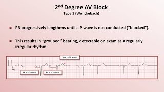 Intro to EKG Interpretation  AV Block [upl. by Lyrem691]