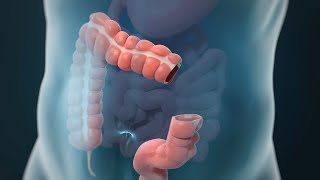 Laparoscopic Colectomy [upl. by Mandeville]