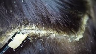 Dandruff scratching removal on head using black combing374 [upl. by Ihpen]