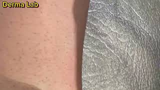 Permanent Hair removal on Candela GentleLASE beforeafter result [upl. by Lubin599]