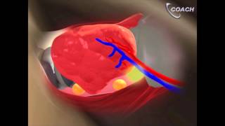 Minimally Invasive Total Thyroidectomy Video [upl. by Neehahs373]