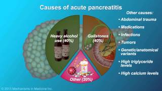 Acute Pancreatitis [upl. by Fernyak]