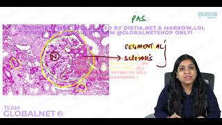 NEPHROTIC SYNDROME By Dr Illa jain khandelwal Pathology by Marrow Video Lecture [upl. by Nidorf997]