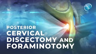 What is Endoscopic Posterior Cervical Discectomy and Foraminotomy [upl. by Nahtanoy]