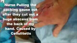 Removing Gauze from Abscess Hand Surgery abscess [upl. by Kloster171]