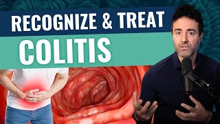 What Ulcerative Colitis Is amp How You Can Treat It Effectively [upl. by Wylen]