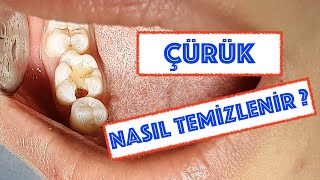 Çürük Diş Nasıl Temizlenir [upl. by Cirdahc808]