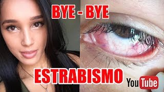 ESTRABISMO  PROCESO DE RECUPERACIÓN Yessi [upl. by Atinihs329]