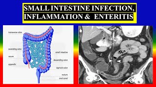 SMALL INTESTINE INFECTION INFLAMMATION amp ENTERITIS  Define  causes  types signs  diagnostic [upl. by Schubert]