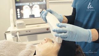 ULTHERAPY  the amazing nonsurgical skin lifting treatment [upl. by Gardiner]