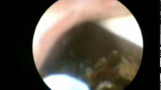 Ureterolitotricia Lasermpg [upl. by Erot]