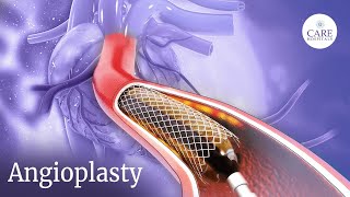 How is Angioplasty Done  Radial Access Procedure  PostTreatment Care After Angioplasty [upl. by Ycnahc]