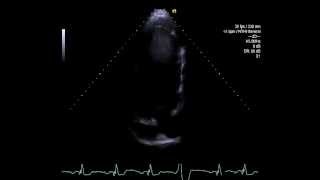 Trombo apical e discinesia com super transdutor de 8 do Simens SC2000 [upl. by Anuayek]