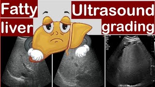 Fatty liver Ultrasound grading [upl. by Elvin]