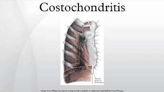 Costochondritis [upl. by Cchaddie329]