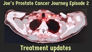 Vlog 2 Prostate Cancer UpdateTreatmentHTSide Effects [upl. by Kevina950]