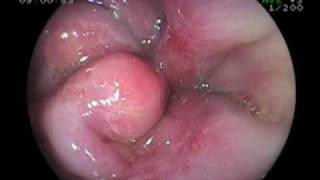 Esophageal Erosion Esophageal Varice Stomach Ulcer and Duodenitis [upl. by Tareyn]