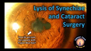 Lysis of Synechiae and Cataract Surgery  Tips amp Tricks [upl. by Margarita903]